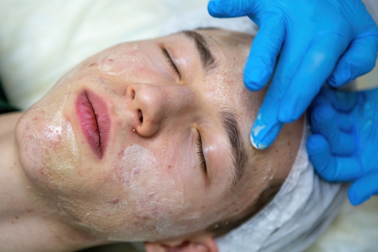 Professional Acne Treatments at a Med Spa What to Expect